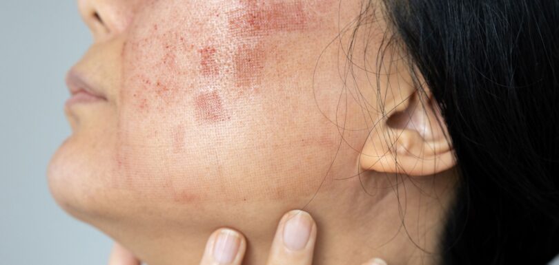 Lupus Eritematoso Sistemico (LES)